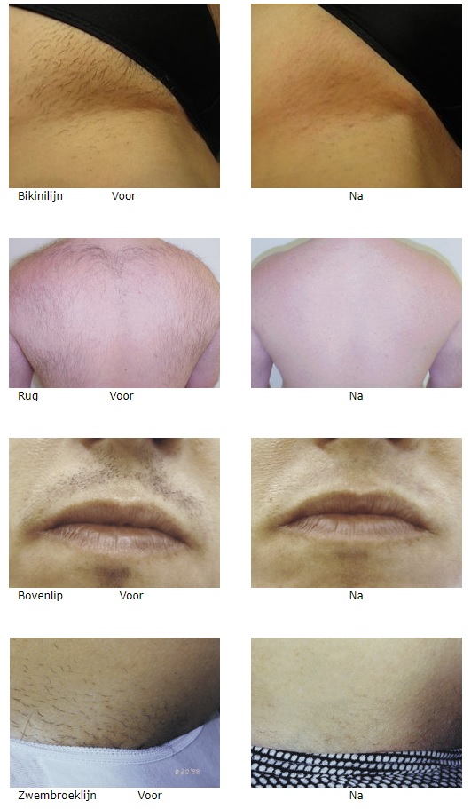 Voor en na fotos laserontharing, definitief ontharen, voor en na foto's permanente ontharing met laser