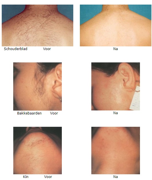 Voor en na fotos ontharen laser, definitieve ontharing, laser ontharing voor en na foto's permanent  ontharing met laser