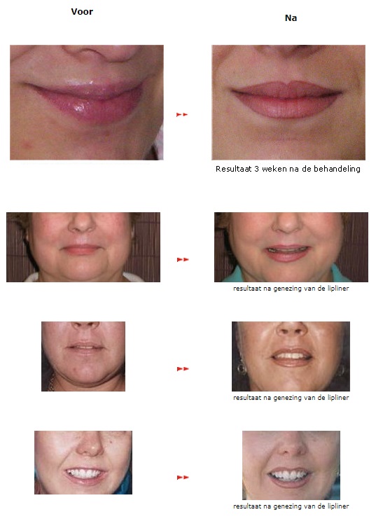 permanente lippenlijn, tattoo lipliner, natuurlijke lippen